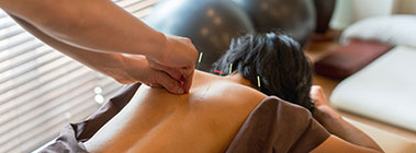 Acupuncture